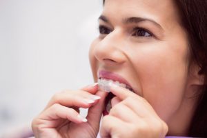 tratamento com Invisalign