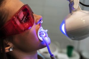 clareamento dental a laser