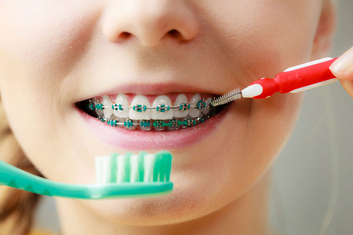 Conheça o Invisalign First, sucesso na ortodontia infantil - SNG