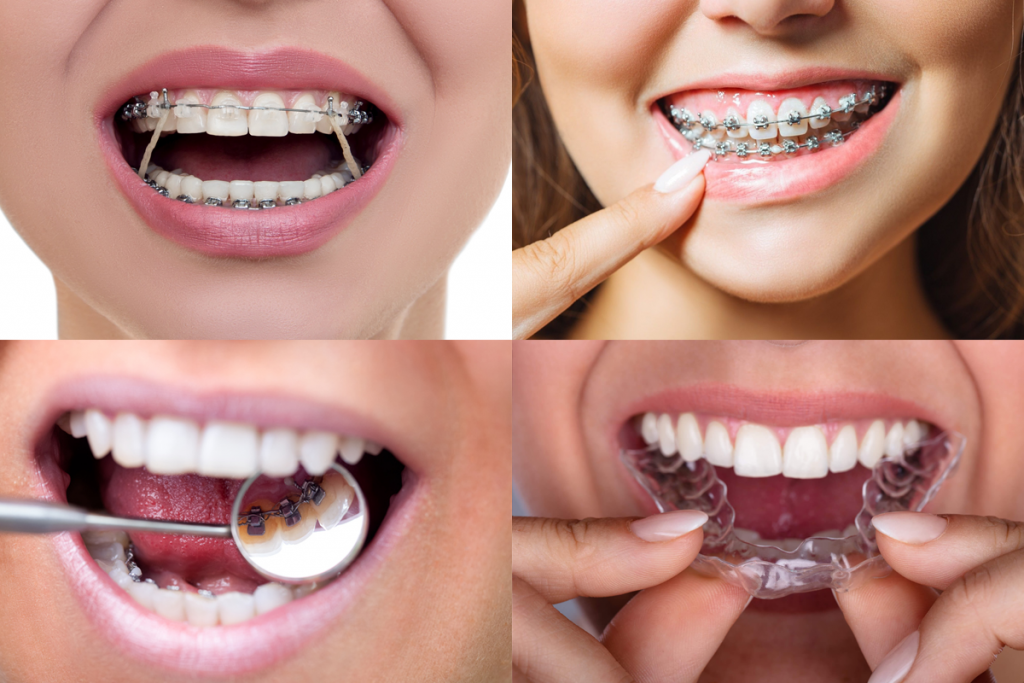 Aparelho Transparente - Invisalign ®